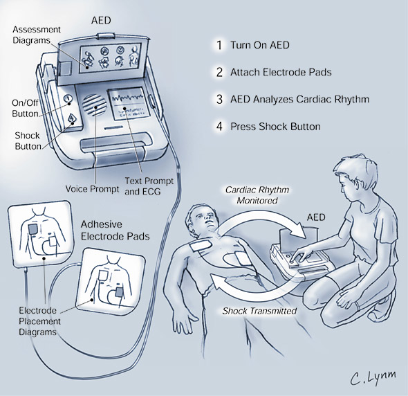 Automated External Defibrillator (AED) | Occupational Health & Safety